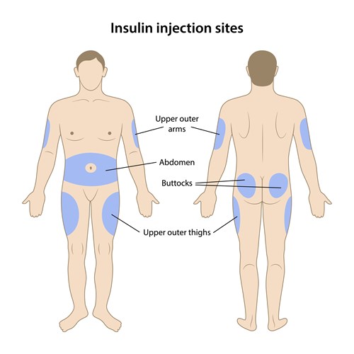 Diagram of human body highlighting possible injection site in the outer things, arms, buttocks or abdomen